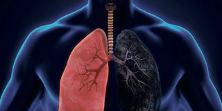 Lung cancer