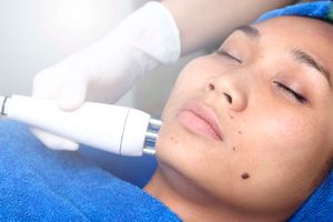 Available treatment options include extractions, steaming, chemical peels, and light therapy.