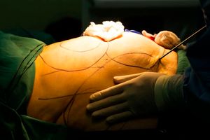 The first step to managing a plastic surgery addiction is to admit that you have the problem and need help.