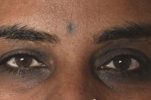 Inflammation from the eyes can cause redness and irritation leading to eye bags.