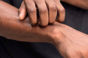 Scratching your skin will spread the rash and cause more discomfort.