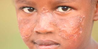 Sharon wanjiku, 7, who is suffering from cutaneous leishmania, at their home in Gitare Village, Gilgil, Nakuru County. 