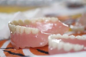 Veneers can also break or chip.