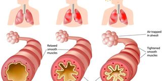 Medications such as beta-blockers used to treat high blood pressure and heart conditions can trigger an asthma attack.