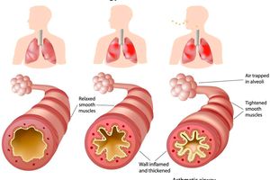 Medications such as beta-blockers used to treat high blood pressure and heart conditions can trigger an asthma attack.