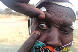 trachoma, blindness, ntds, neglected diseases