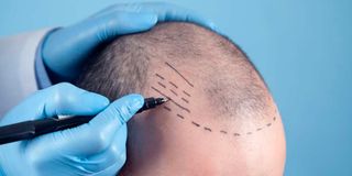 organ transplant, organ donation, hair transplant
