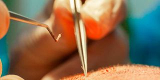 skin transplant,organ donation, organ transplant