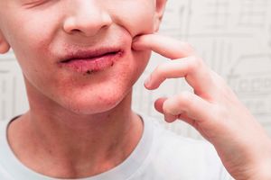 mouth rash, mouth infection, red rash