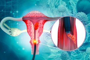 endometriosis, uterus, cancer