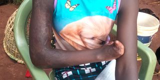 Roselyne Nakhumicha, 16, shows her amputated arm  during an interview with Nation.Africa at her parents' home in Trans Nzoia