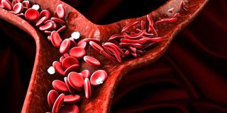 Sickle cell disease