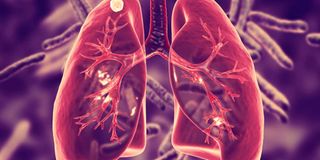 Secondary tuberculosis in lungs.