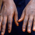 mpox hands
