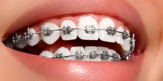 Braces 