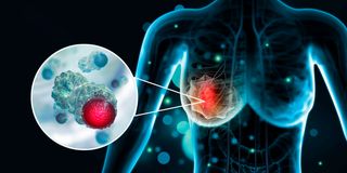 Breast cancer 