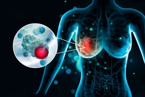 Breast cancer 