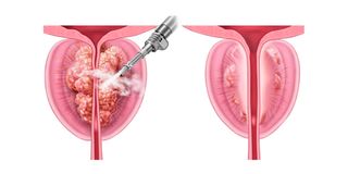 An illustration showing how Rezum water vapor therapy is conducted