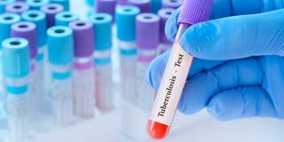 TB test